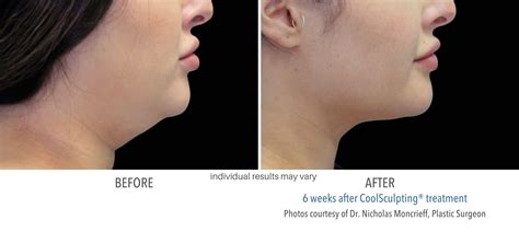 coolsculpting results timeline|How Long Does It Take To See Results .